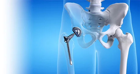 total hip replacement surgery in Delhi NCR